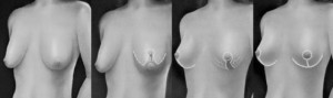 Frost Plastic Surgery Breast Lift Procedure